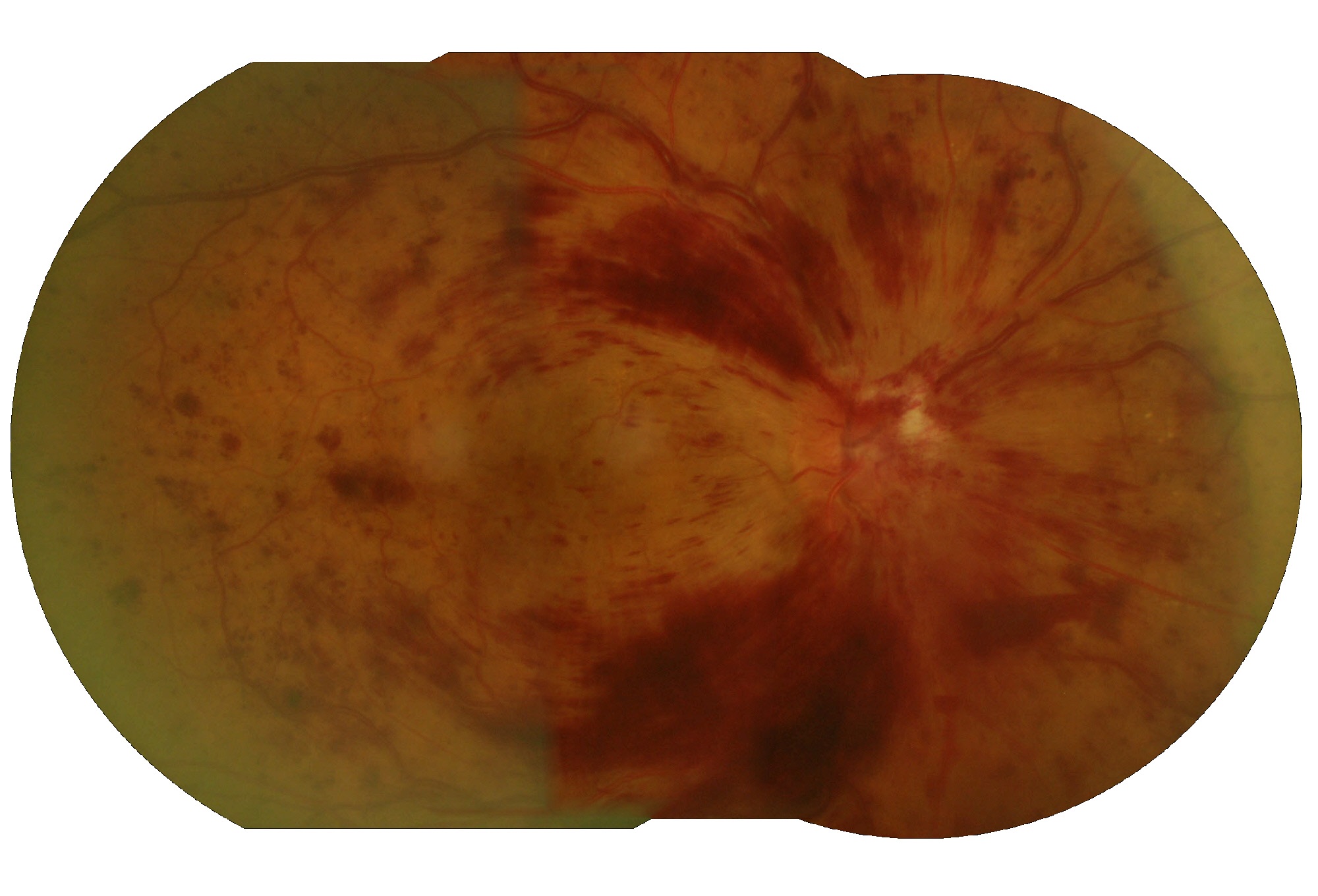 Occlusione massiva emorragica Vena Centrale Retina